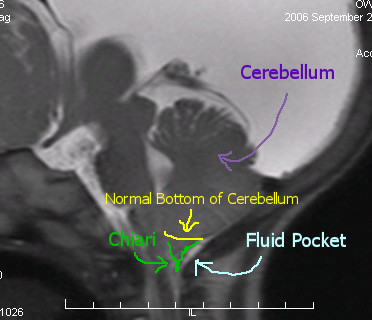 Chiari-Labeled.jpg