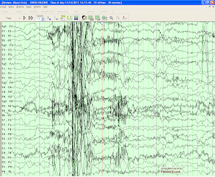 eeg-not-seizure.jpg