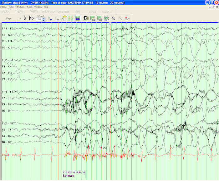 eeg-seizure.jpg